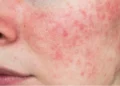 What Is the Best Treatment for Rosacea in Australia? 10 Roseacea