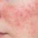 What Is the Best Treatment for Rosacea in Australia? 9 Roseacea