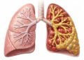 Bronchiectasis