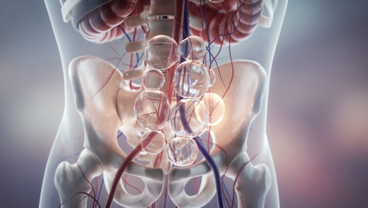 Tarlov Cysts: The Trauma Connection 1 Tarlov Cysts