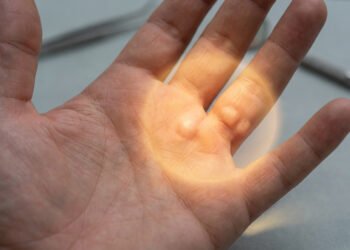 Dupuytren'S Disease Early Treatment