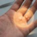 A Promising New Approach Targets the Root Cause of This Progressive Hand Condition 10 Dupuytren'S Disease Early Treatment